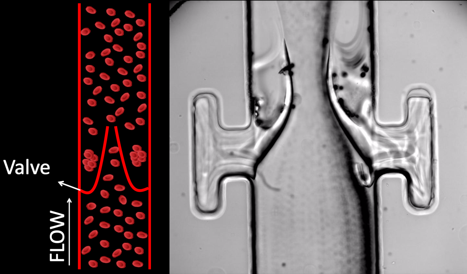 Deep vein thrombosis (DVT)